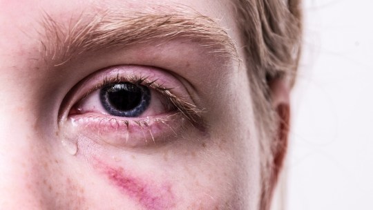 An injured and tearing eye.